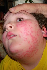 Allergies on boy skin