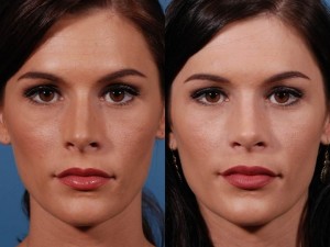 Nose Job result on woman