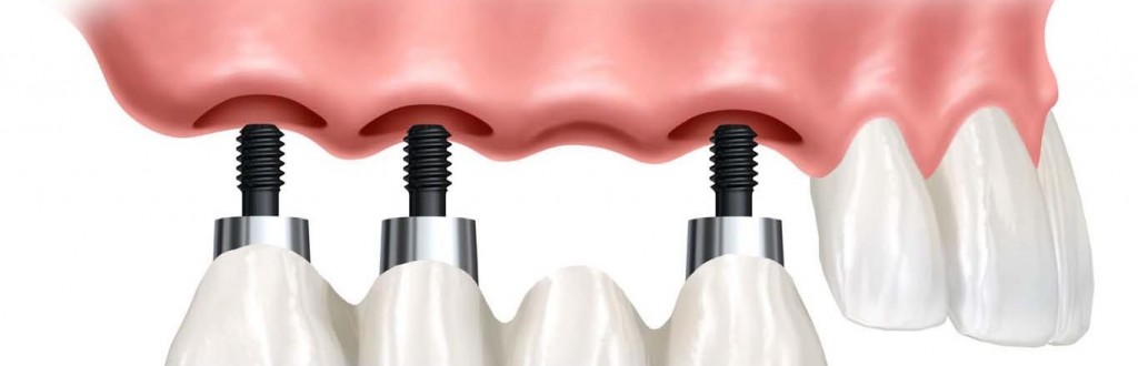 implant teeth illustration