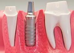 implant tooth 