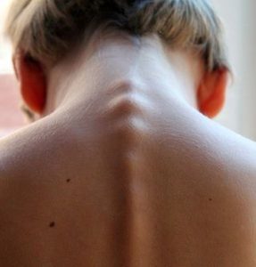 boy with Spinal stenosis