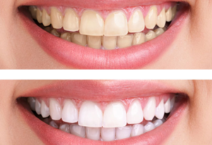 Teeth whitening services